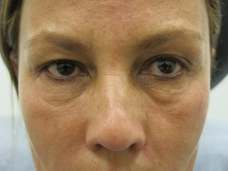 Cheek Augmentation Before Photo for Patient #1223
