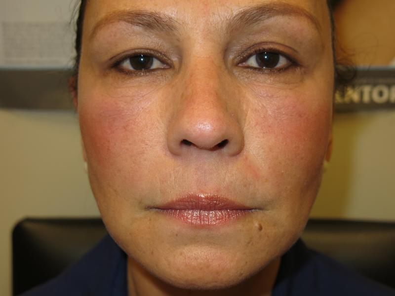 Cheek Augmentation After Photo for Patient #1223