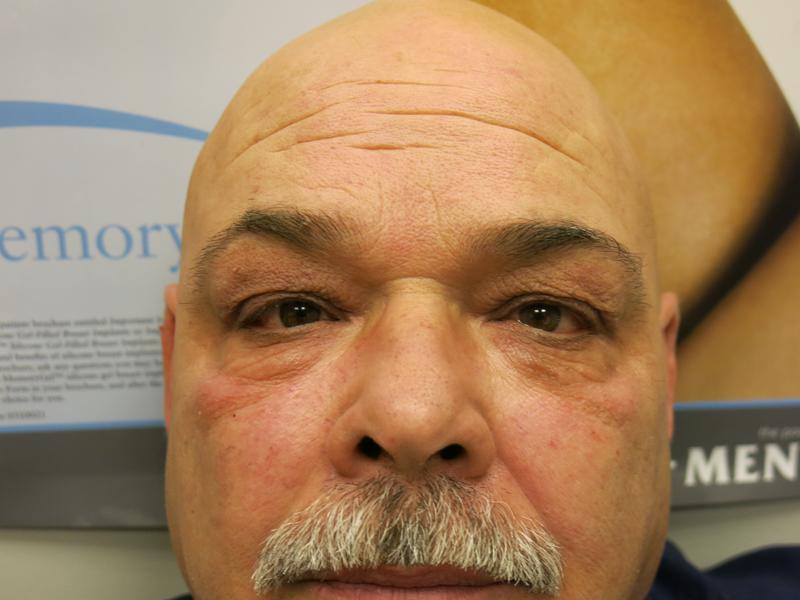 Cheek Augmentation After Photo for Patient #1221