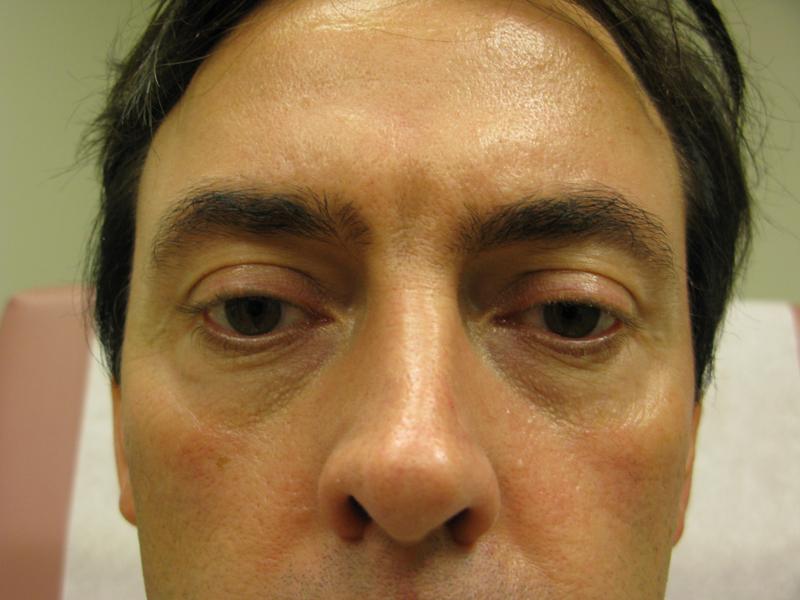 Cheek Augmentation Before Photo for Patient #1219