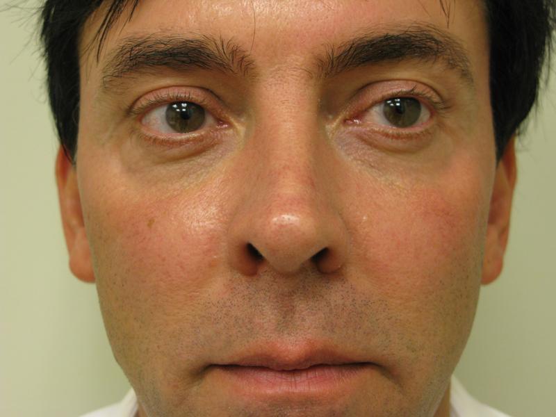 Cheek Augmentation After Photo for Patient #1219