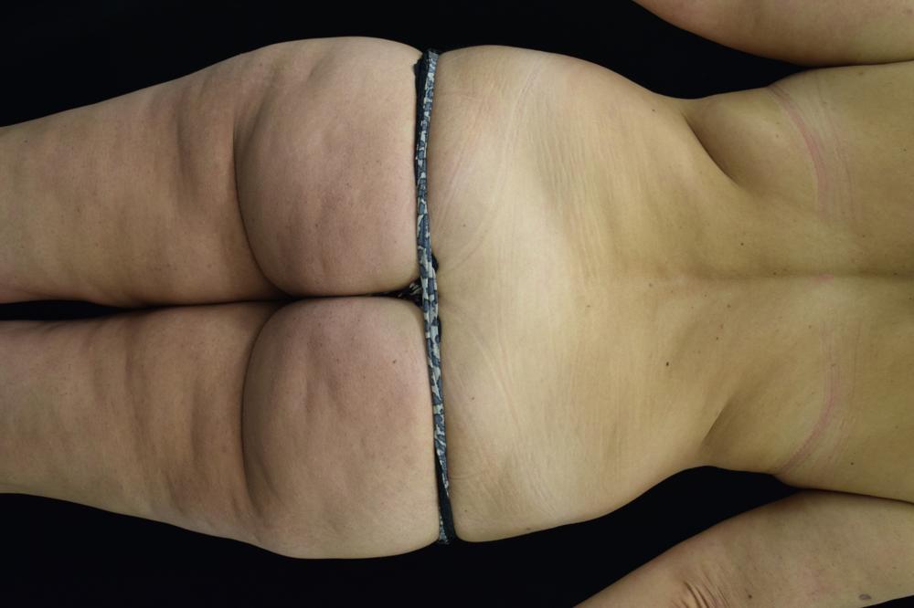 Fat Transfer Before Photo for Patient #1067