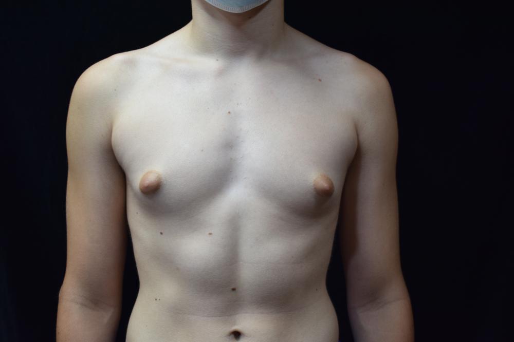 Gynecomastia Before Photo for Patient #2671
