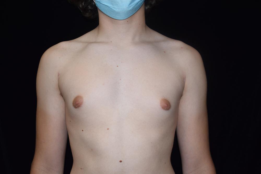Gynecomastia After Photo for Patient #2671
