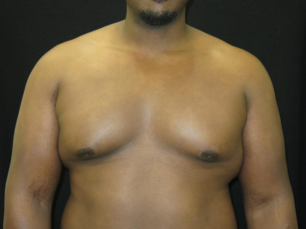 Gynecomastia Before Photo for Patient #1097
