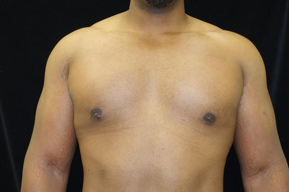 Gynecomastia After Photo for Patient #1097