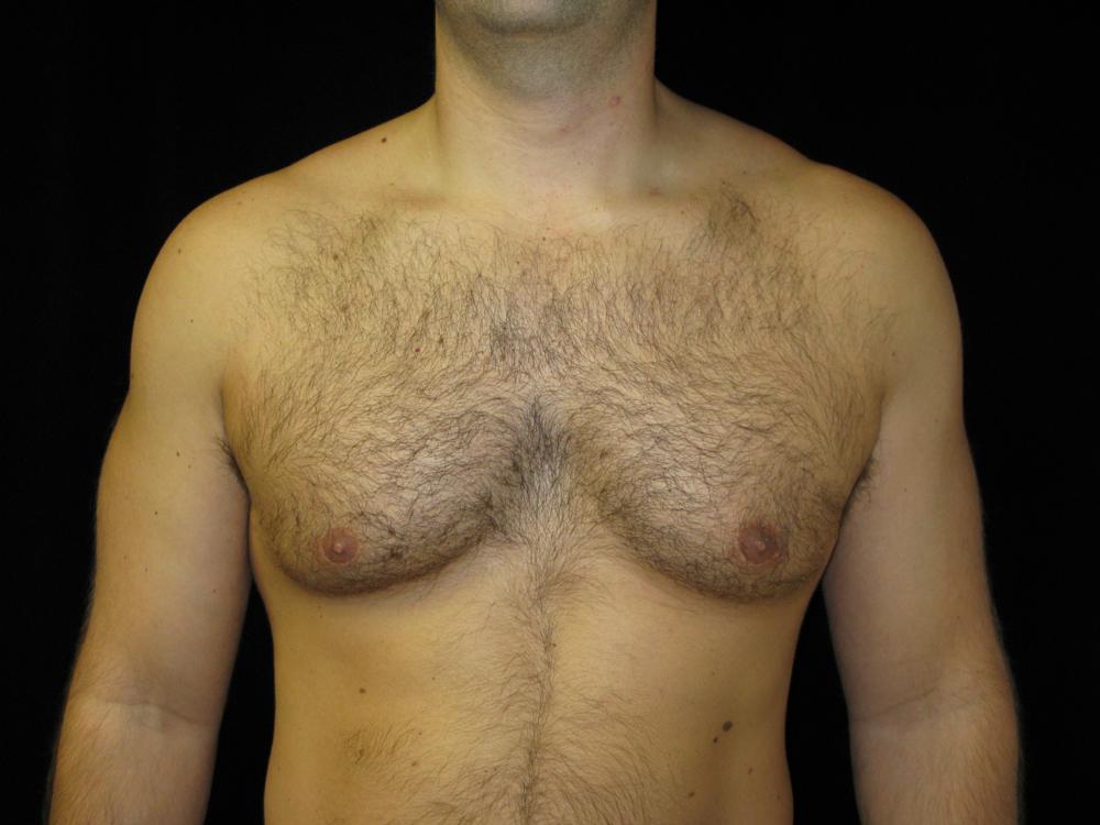 Gynecomastia Before Photo for Patient #1099