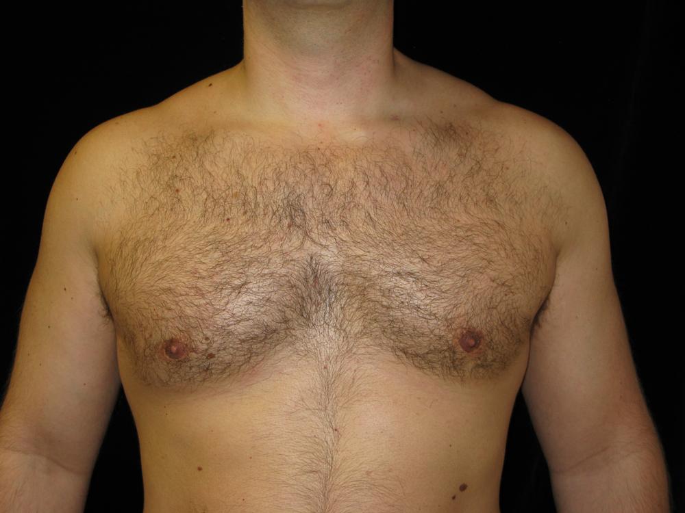 Gynecomastia After Photo for Patient #1099