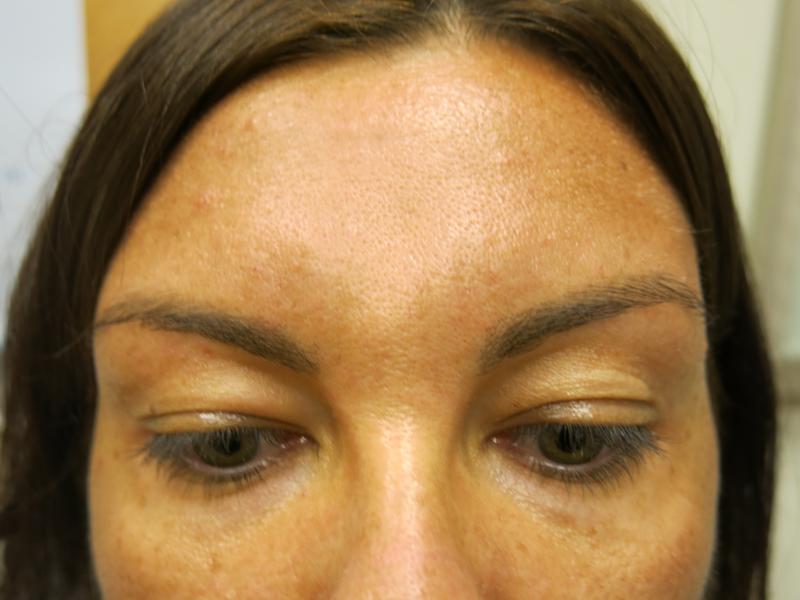 Injectable Glabella After Photo for Patient #1250