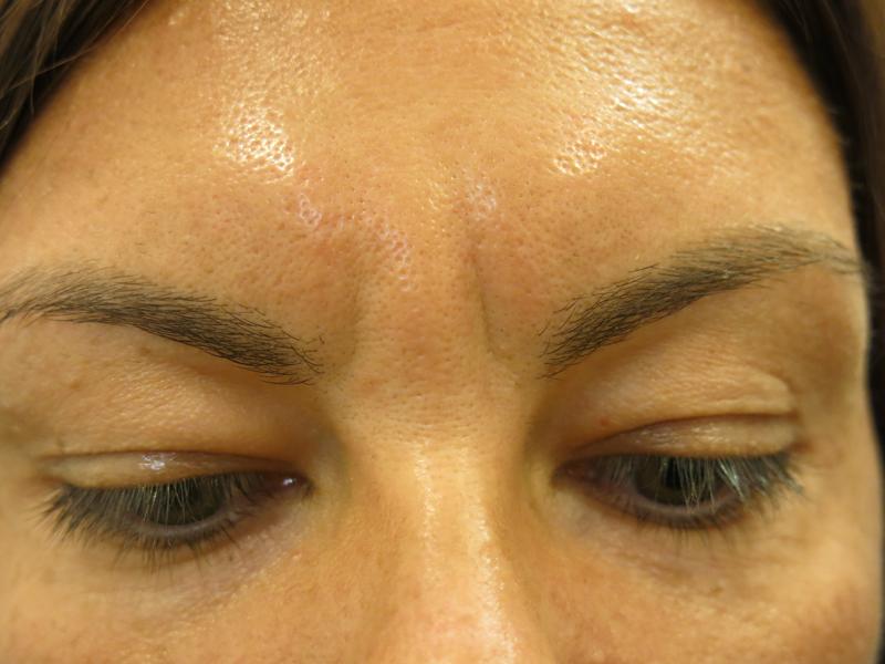 Injectable Glabella Before Photo for Patient #1250