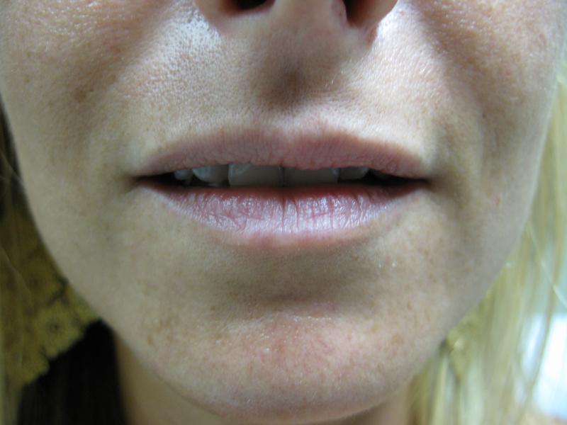 Lip Fillers Before Photo for Patient #1315