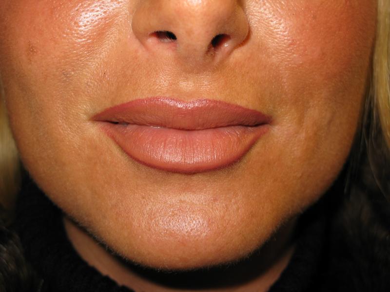 Lip Fillers After Photo for Patient #1315