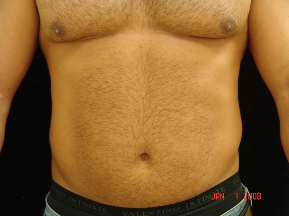 Liposuction Before Photo for Patient #1055