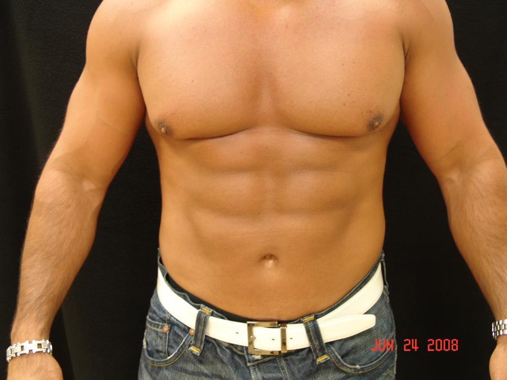 Liposuction After Photo for Patient #1055