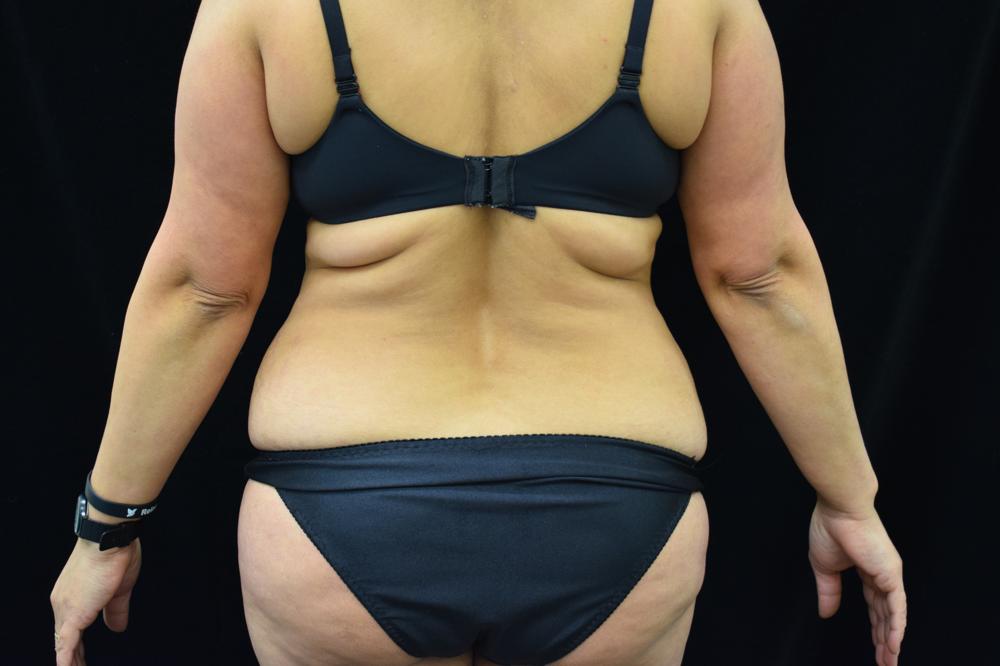 Liposuction Before Photo for Patient #1056