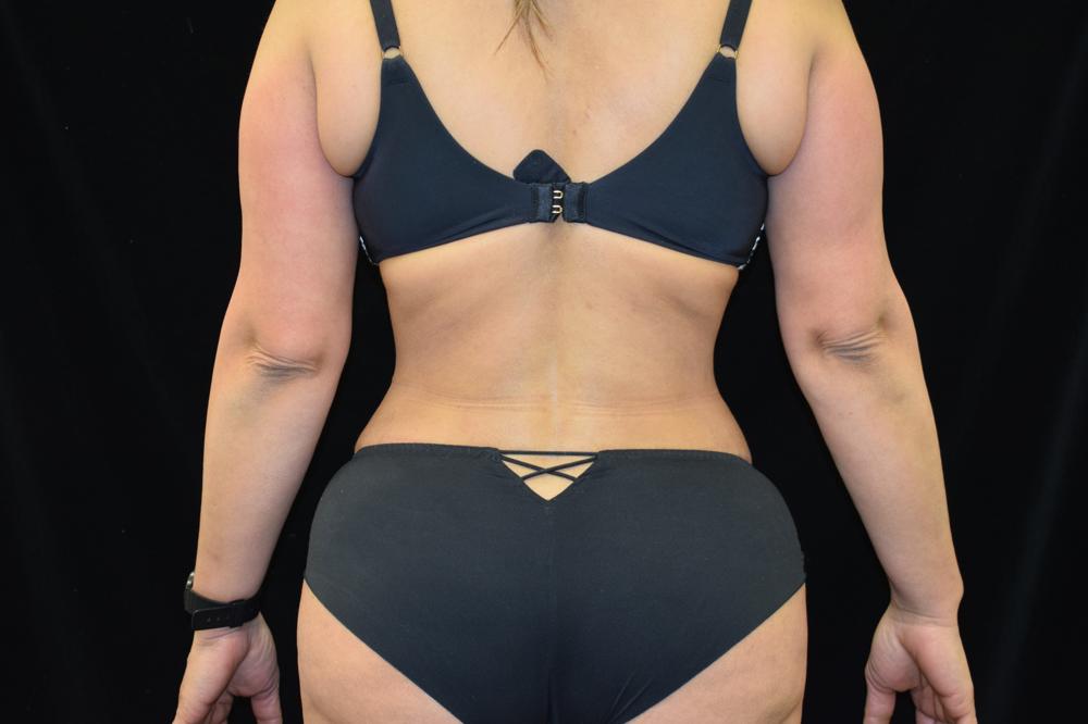 Liposuction After Photo for Patient #1056