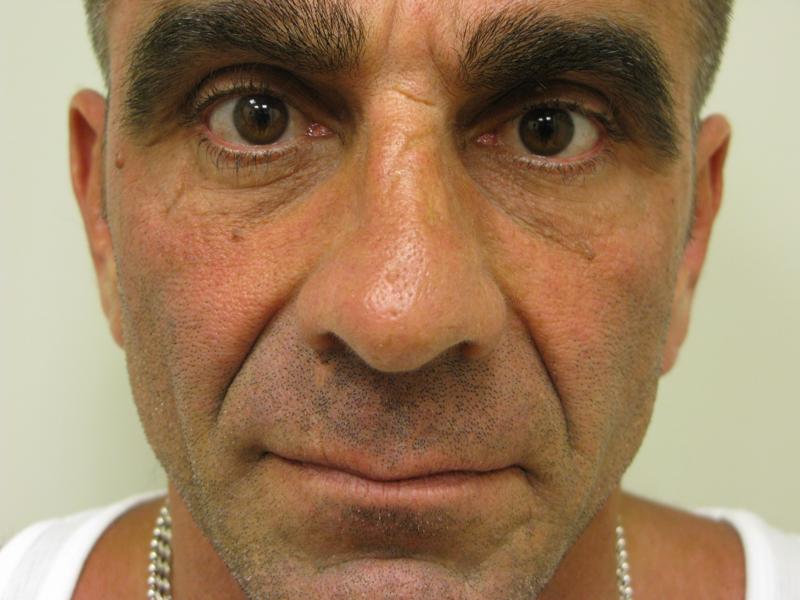 Nasolabial Folds Before Photo for Patient #1289