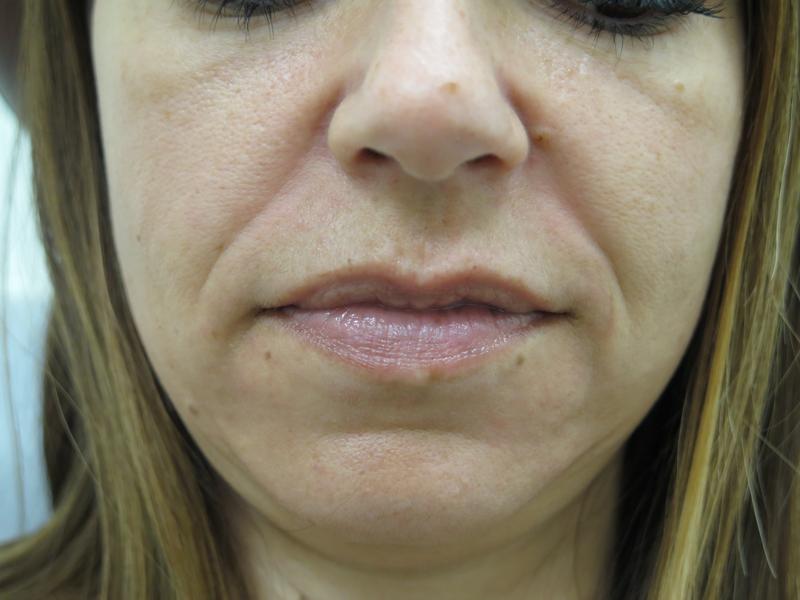 Nasolabial Folds Before Photo for Patient #1288