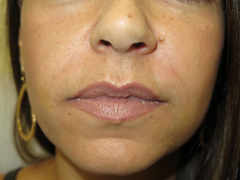 Nasolabial Folds After Photo for Patient #1288