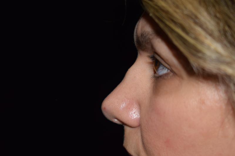 Non Surgical Rhinoplasty Before Photo for Patient #1238