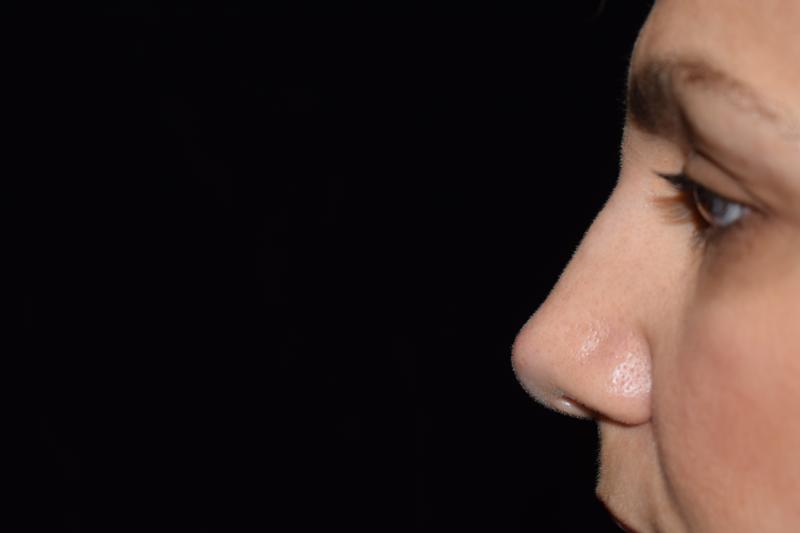 Non Surgical Rhinoplasty After Photo for Patient #1238