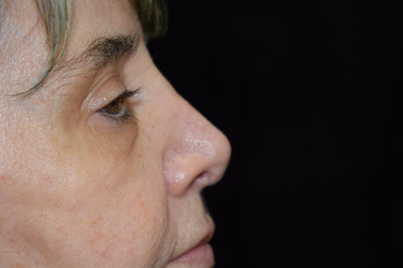 Non Surgical Rhinoplasty After Photo for Patient #1236