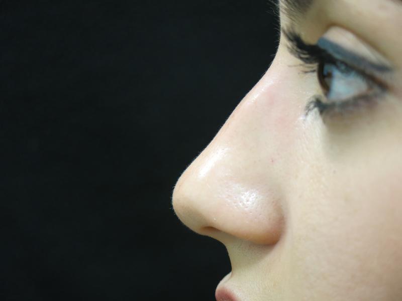 Non Surgical Rhinoplasty Before Photo for Patient #1239