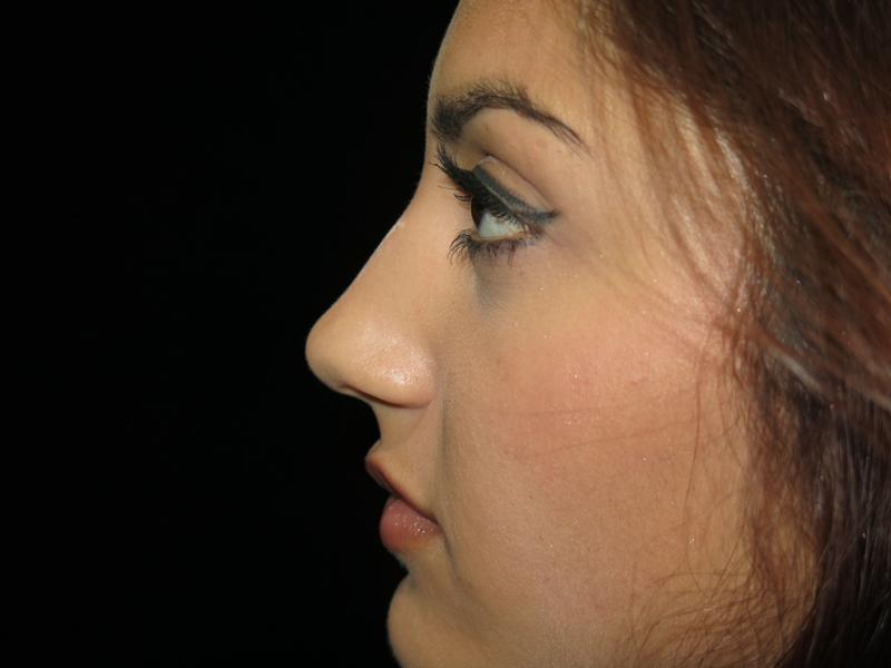 Non Surgical Rhinoplasty After Photo for Patient #1239