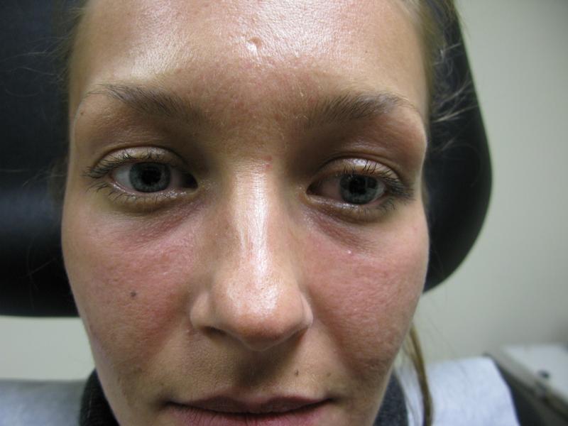 Tear Trough Before Photo for Patient #1205