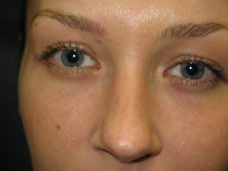 Tear Trough After Photo for Patient #1205