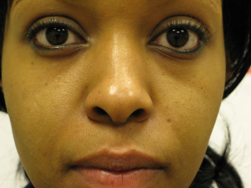 Tear Trough Before Photo for Patient #1204
