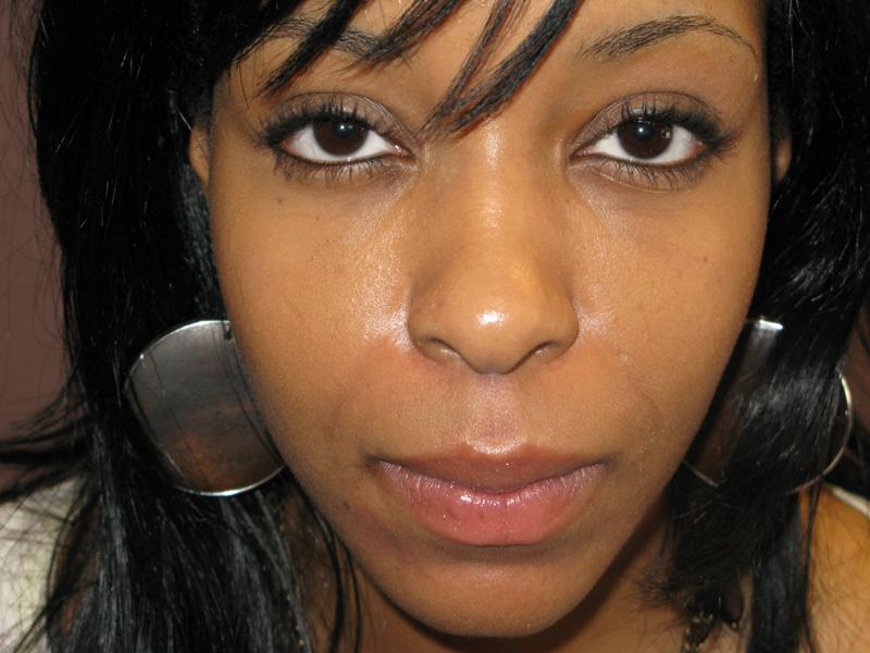 Tear Trough After Photo for Patient #1204