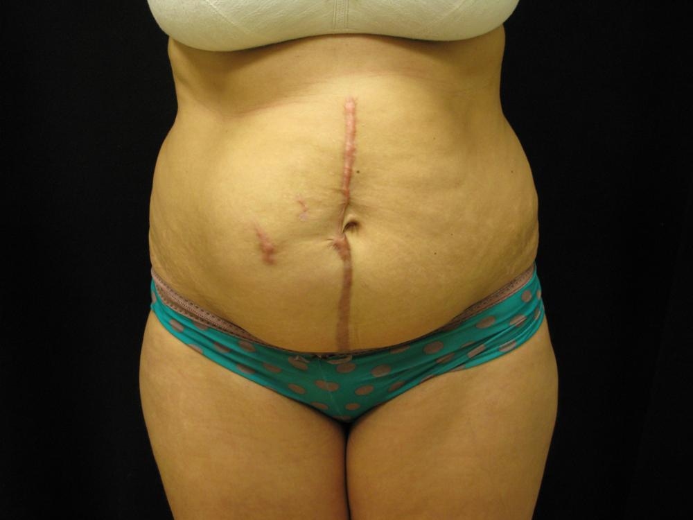 Tummy Tuck Before Photo for Patient #1874