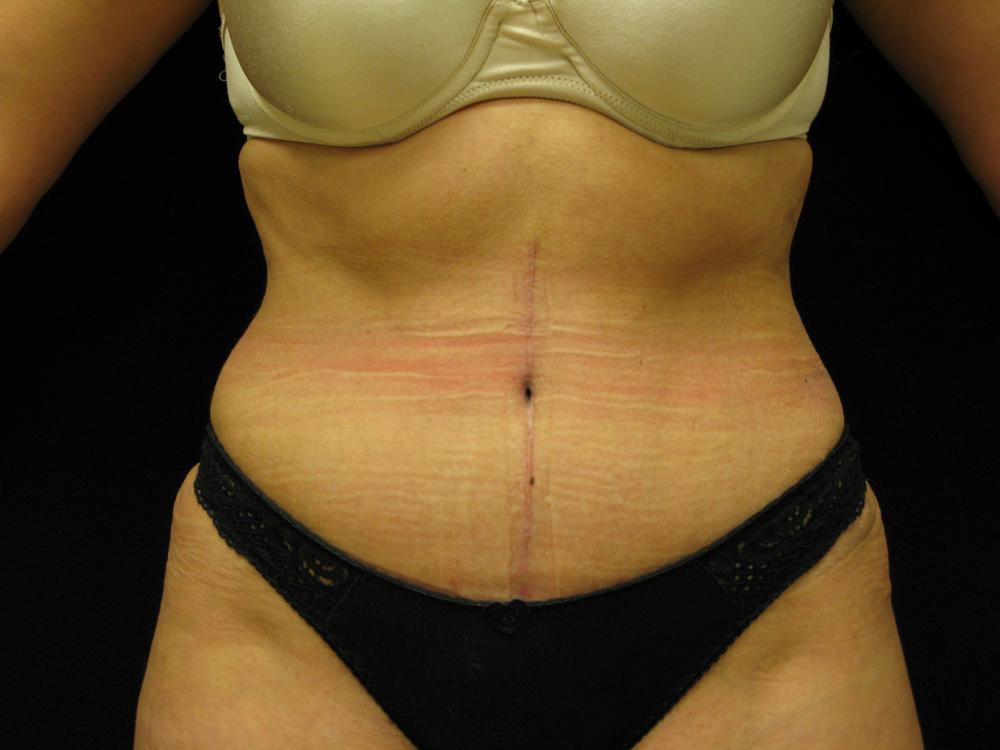 Tummy Tuck After Photo for Patient #1874
