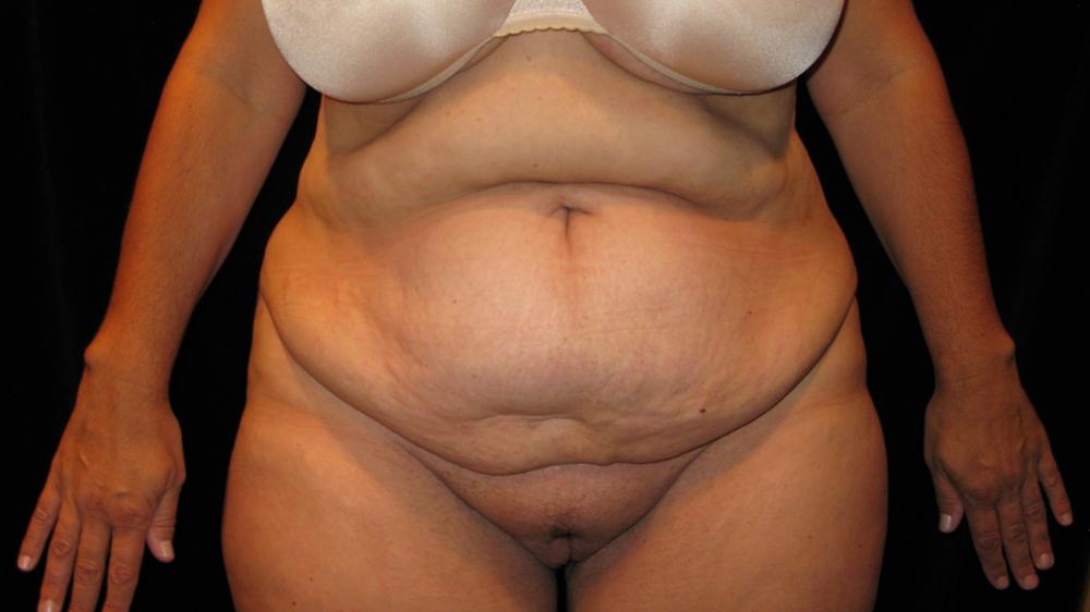 Tummy Tuck Before Photo for Patient #1873