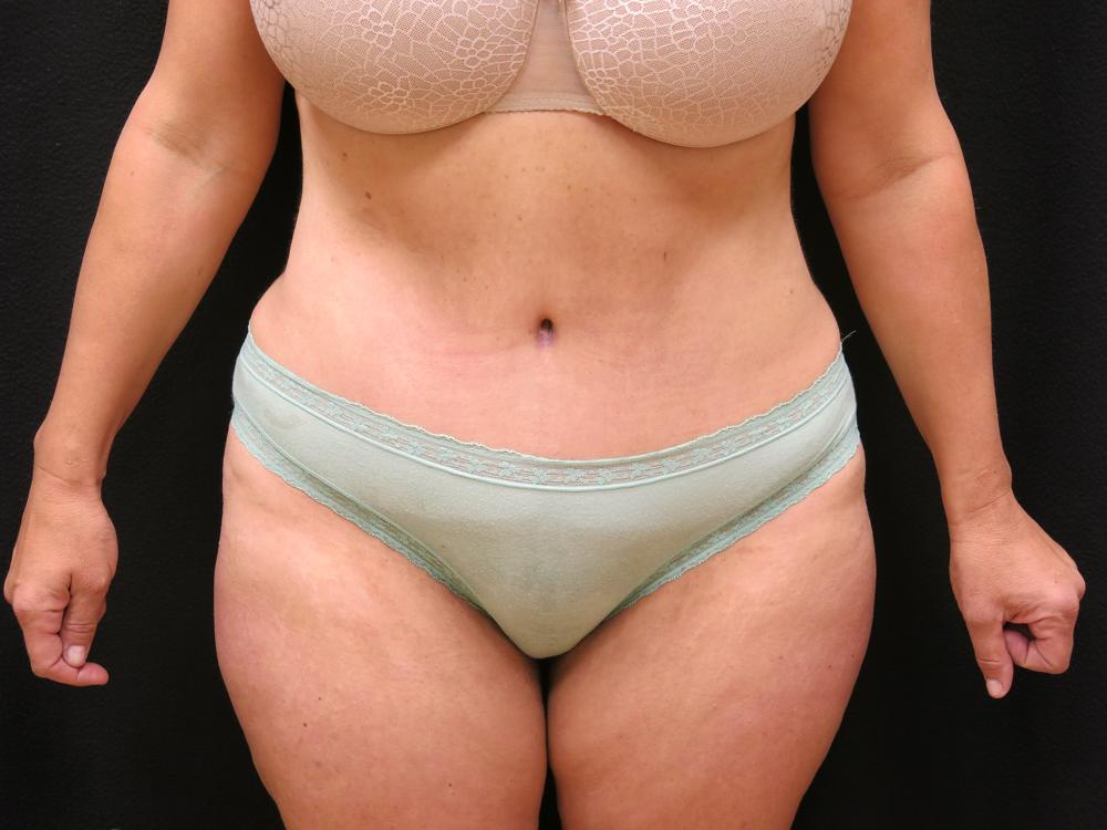 Tummy Tuck After Photo for Patient #1873